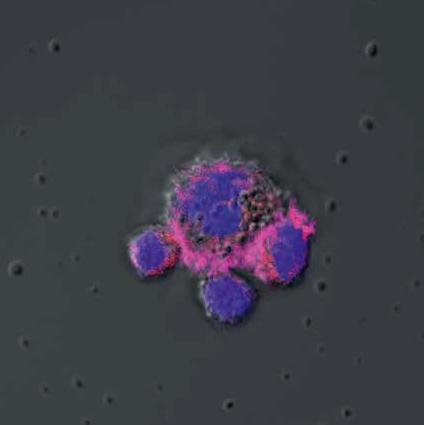 3 T-Zellen attackieren eine Tumorzelle